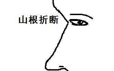 震惊 山根断的人竟是这样的! 震惊 山根断的人竟是这样的!