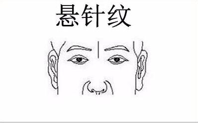 悬针纹怎么去除